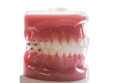 CERAMIC BRACES