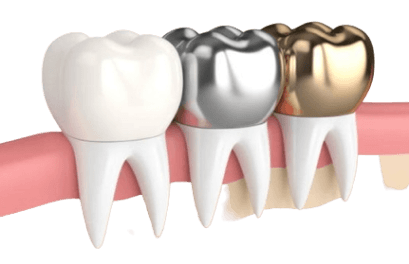 DENTAL CROWNS