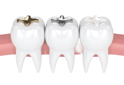 DENTAL FILLINGS