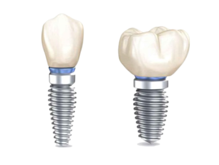 DENTAL IMPLANTS