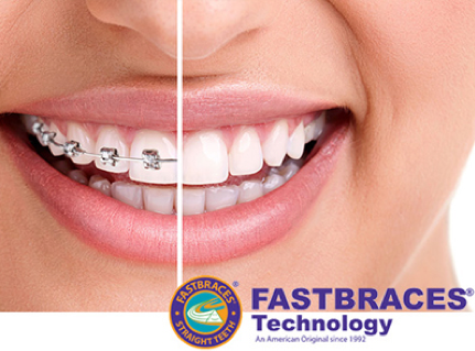 FAST BRACES