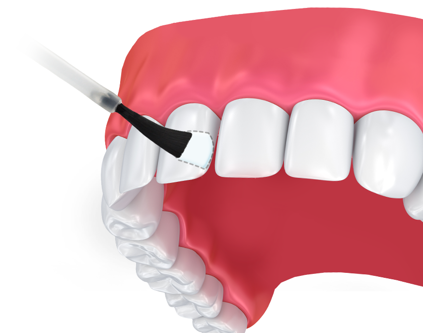 FLUORIDE TREATMENT