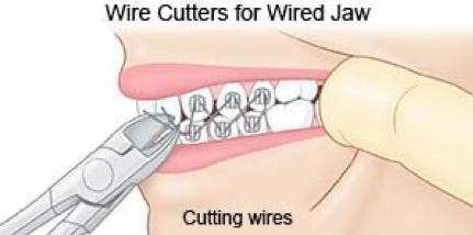 JAW WIRING