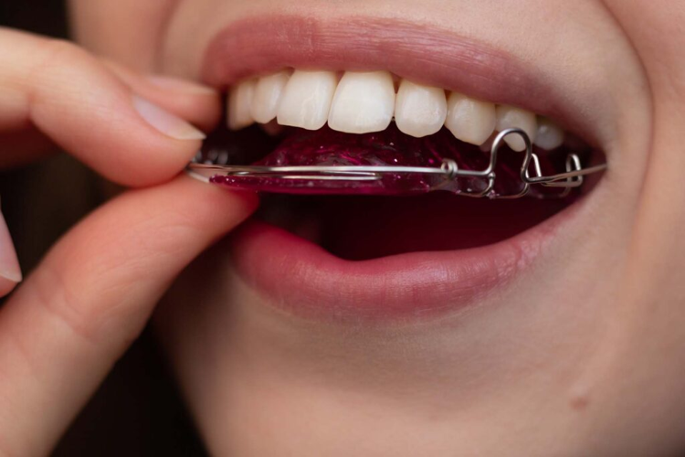 RETAINERS